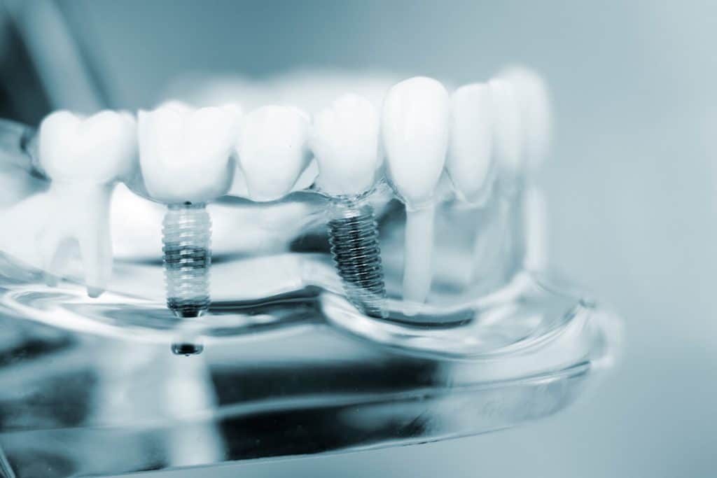 4 Myths About Dental Implants