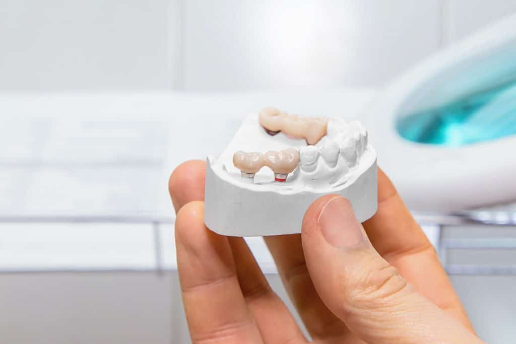 The Pros and Cons of Dental Bridges