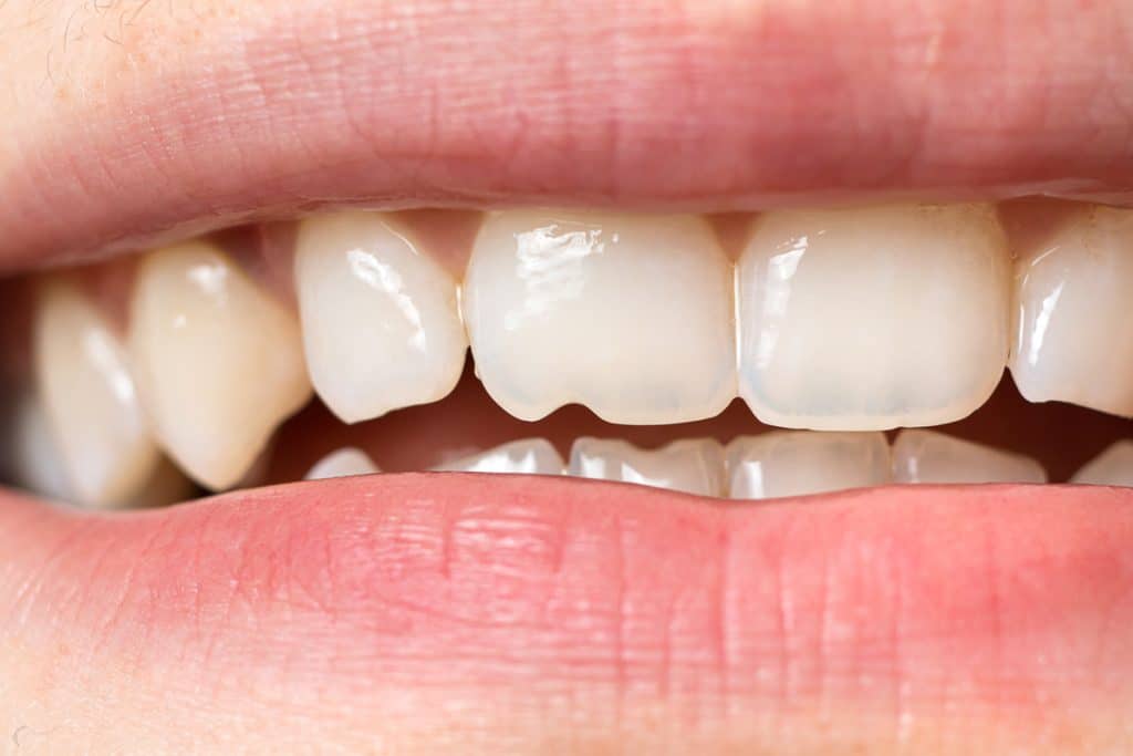 5 Signs You Might Have a Cracked Tooth