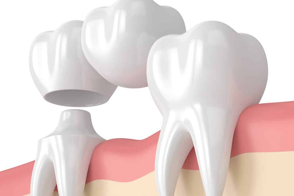 Can A Dental Bridge Be Removed And Recemented?