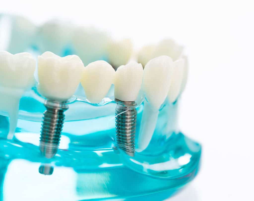 Mini-Implants vs. Full-Size Dental Implants