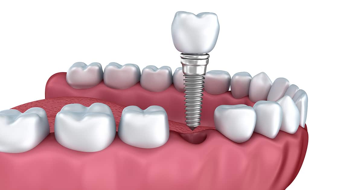 Dental Implant Illustration