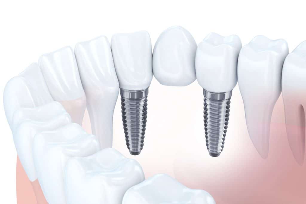 How Long Do Dental Bridges Last?