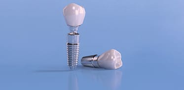 Dental Implants Image