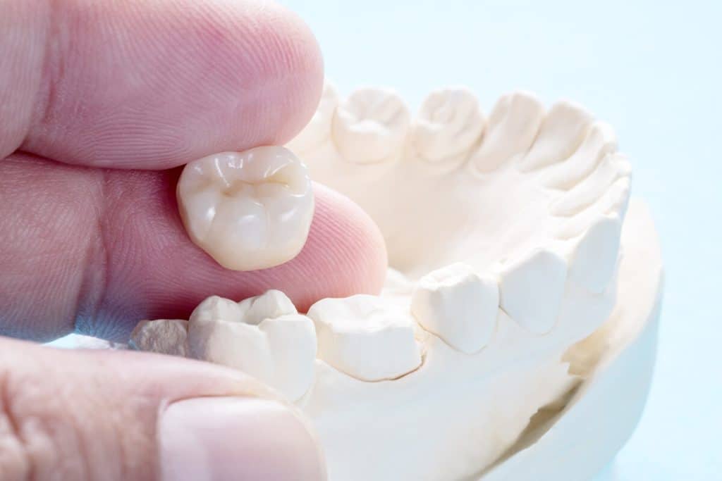 What is the Typical Cost of a Dental Crown?