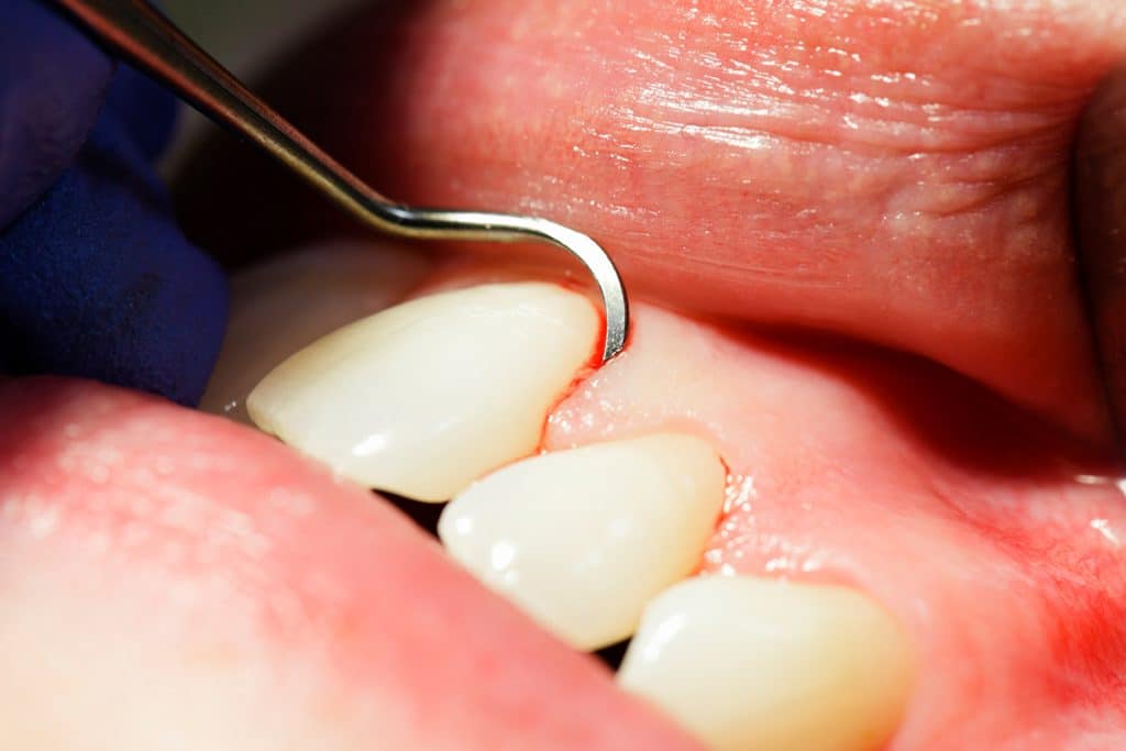 Why Am I Bleeding After My Tooth Was Removed?
